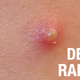 Illustration for article titled Radishes May Prove to Be Acnes Worst Nightmare